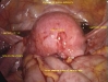 Pelviendometriosisevera.jpg