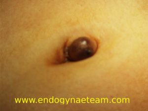 endometriosi ombelicale