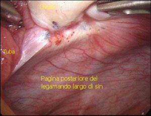 endometriosi della fossetta ovarica sinistra